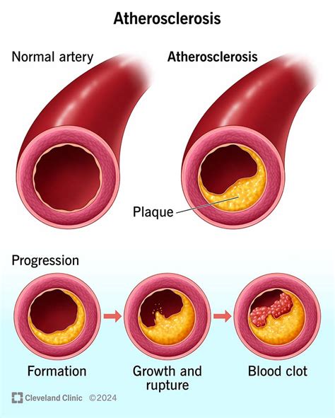 how is arteriosclerosis diagnosed